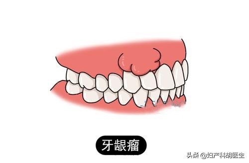 孕期牙疼可别忍,孕期牙疼真的是要命