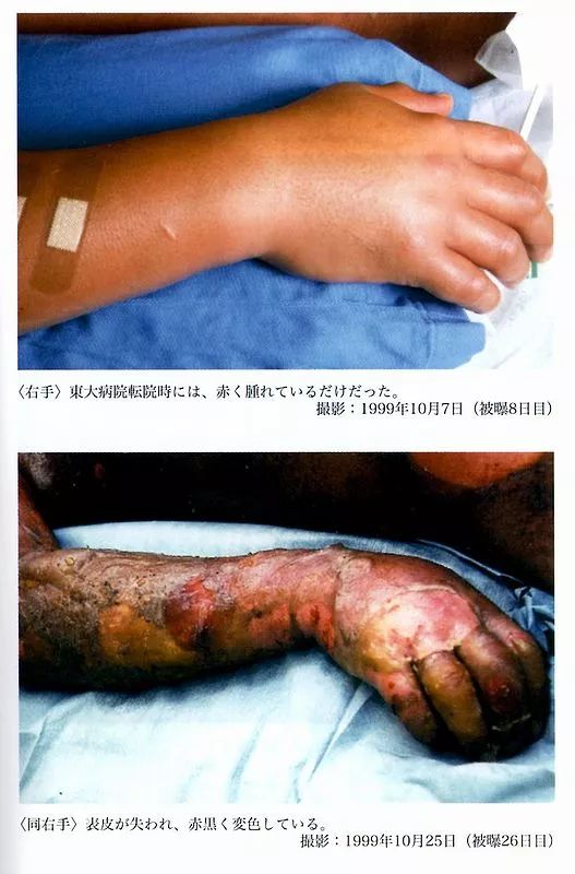 83天痛不欲生的活体腐烂，他在一次核事故后缓慢死去