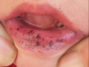 宝宝突然之间长出黑斑怎么解决,儿童黑斑快速增多