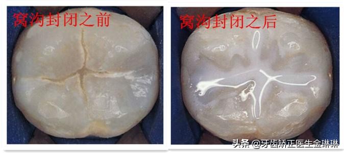 牙齿窝沟有黑线能窝沟封闭吗,窝沟封闭小知识