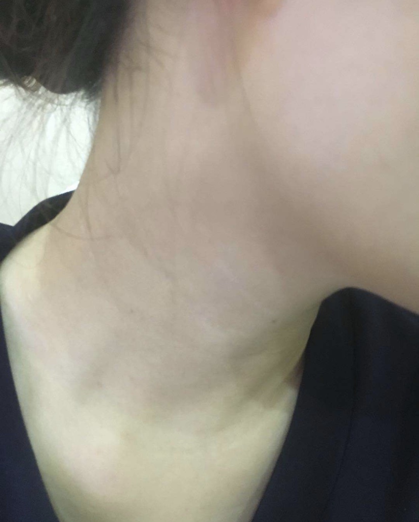 去脖子颈纹最好的方法真实有效,去脖子后颈纹最好的方法