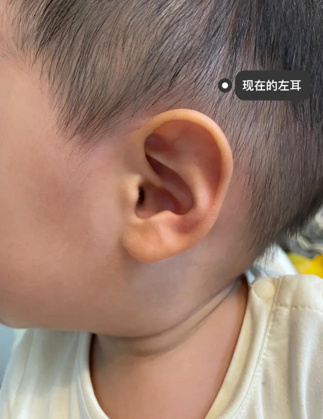 宝宝刚出生耳廓畸形，现在长成什么样了？