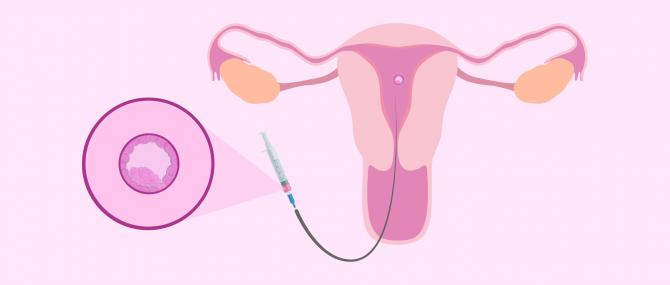 移植试管婴儿注意保暖吗,冻胚胎移植后注意事项和饮食禁忌