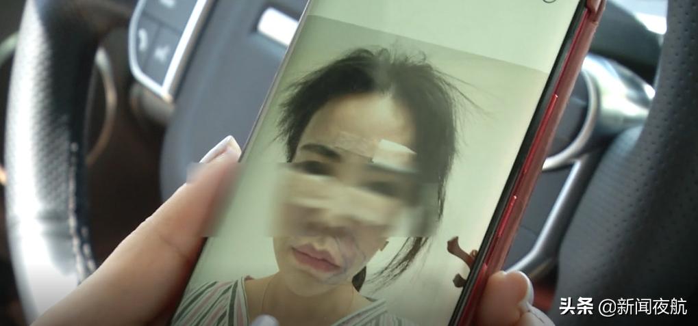 花了300万做全脸填充,花了1万4做了面部填充