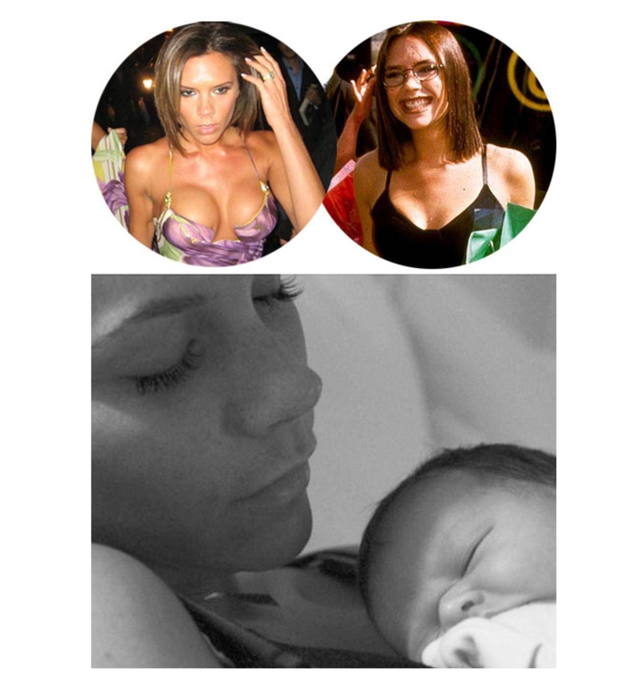 隆胸后母乳涨奶怎么办,隆胸后母乳少是怎么回事