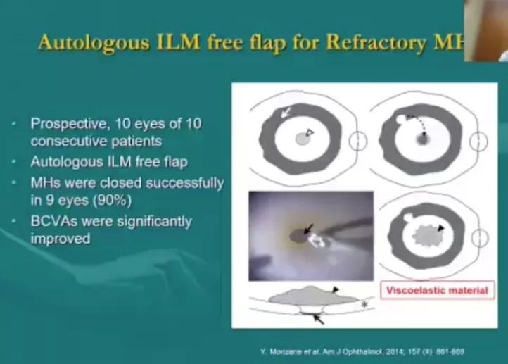 视网膜裂孔未来有希望痊愈,眼底黄斑裂孔能治愈吗最新消息