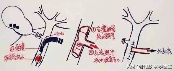 胆囊结石切除后胆管还会结石吗,胆囊结石合并胆息肉怎么办