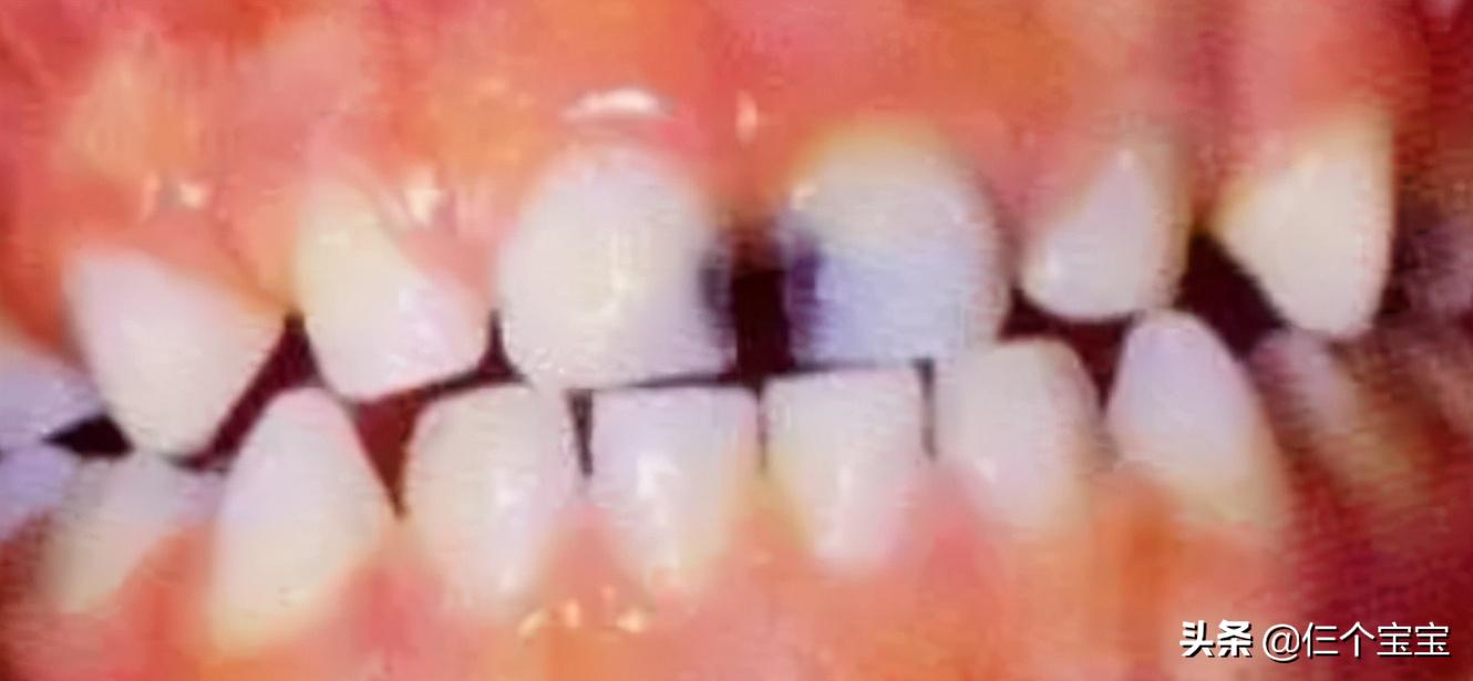 草莓籽藏在牙里发芽了,草莓籽在嘴里发芽