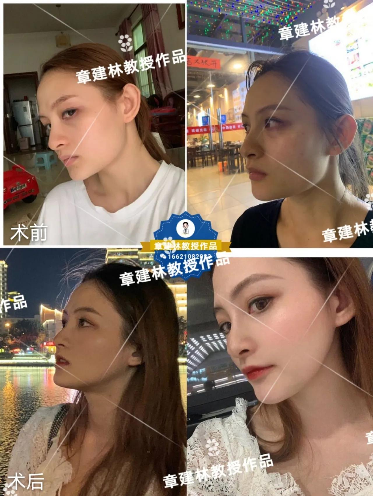 大小脸磨骨改脸型一般花费是多少,磨骨改脸型要多少钱有什么风险