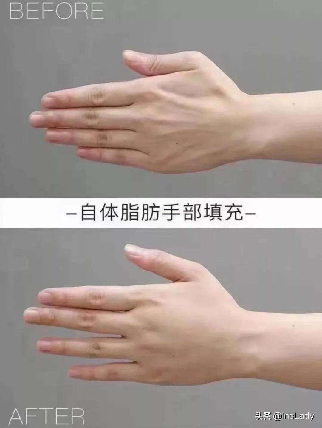 整容毁掉容貌的女子,一名女子整容却毁了她一生