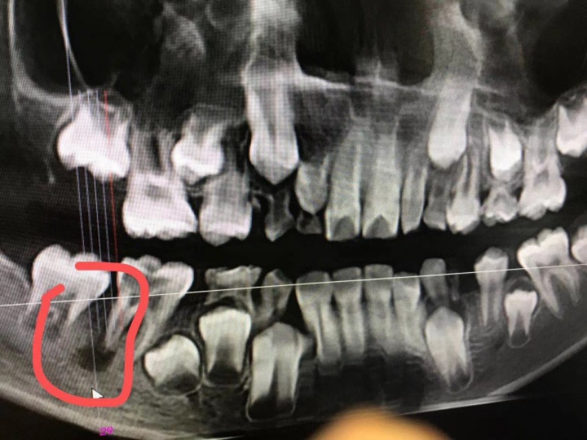 牙源性上颌窦炎牙龈瘘管,牙源性脓肿的症状