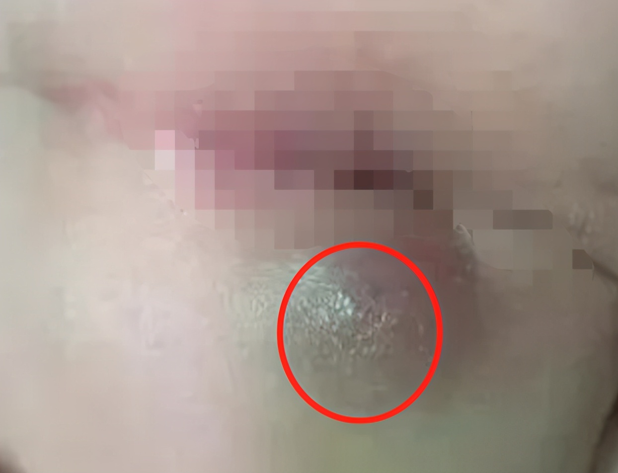 这种病千万别拖:6斤小龙虾下肚,诱发肛周脓肿