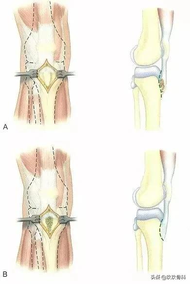 青少年膝盖疼骨骺炎怎么缓解,胫骨结节骨软骨炎怎么缓解疼痛