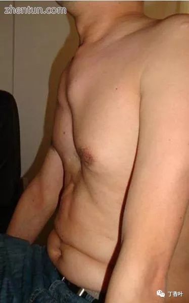 马凡综合征面容,马凡综合征最新标准