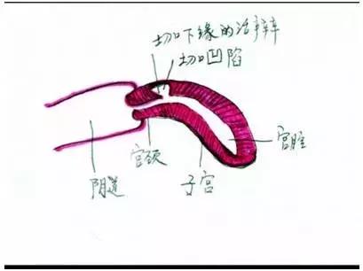 子宫憩室手术后怎么调理身体,子宫憩室手术后还会有憩室吗