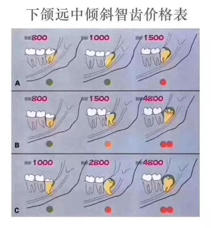 埋得越深，分手费越高——你所不知道的拔智齿收费依据