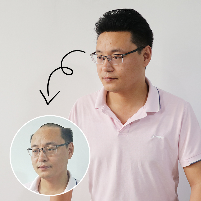 织发补发山东,织发补发的发展