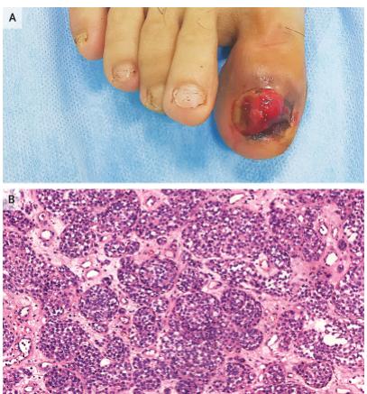 医声-有医招⑪|指甲突然变黑了？你可能得了这种病