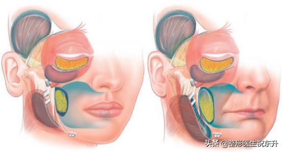 55岁如何做面部提升术好,40岁适合哪种面部提升手术