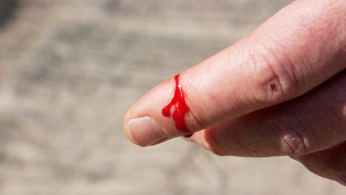 皮肤莫名其妙出现划伤流血怎么办,生活中被划伤了伤口怎么处理