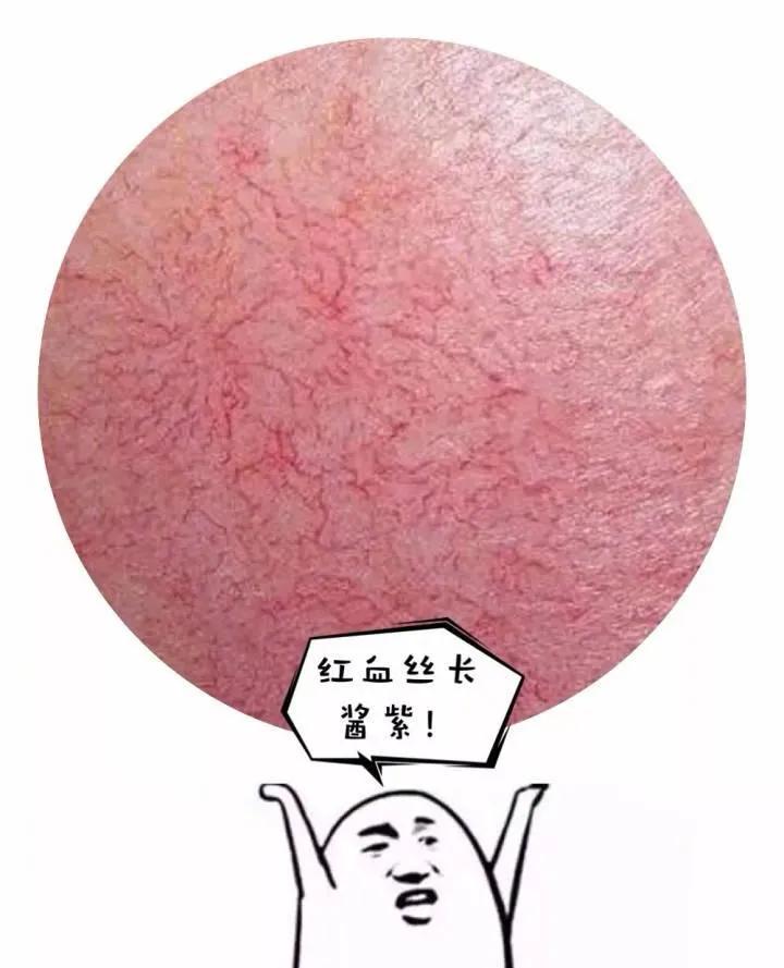 脸上长“*血丝红**”，医生：平时的坏习惯要纠正！