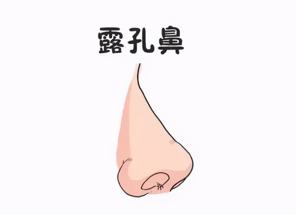 鼻头大鼻孔外露的怎么手术最合适,鼻边缘外露可以做鼻孔缩小术吗