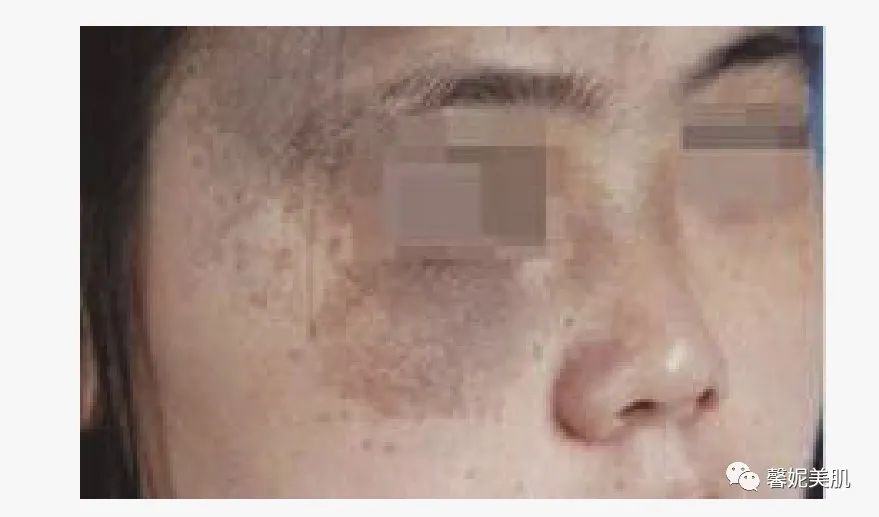 褐青色痣和太田痣区别,褐青色痣是太田痣吗