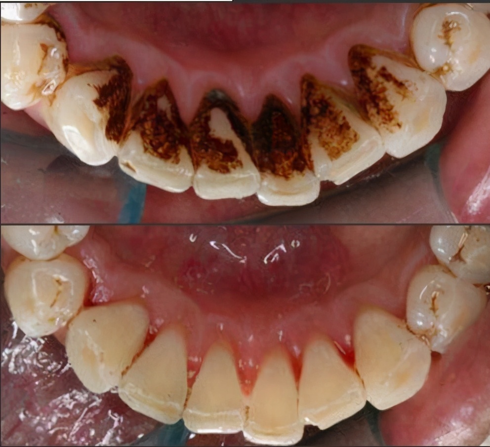 牙齿黄怎么办三招教你黄牙变白牙,黄牙黑牙真的能洗白吗