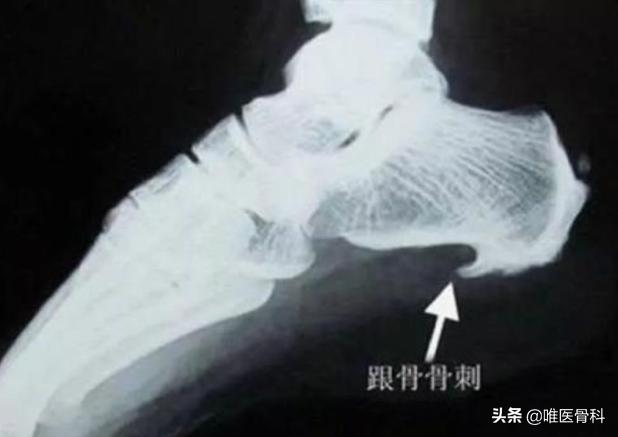 足底筋膜炎可以快走吗,足底筋膜炎快走