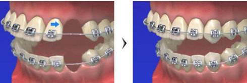 严重的龅牙可以磨掉吗,严重龅牙可以矫正吗