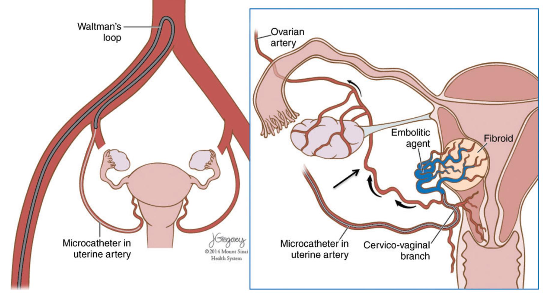 子宫肌瘤用介入栓塞会有后遗症吗,介入栓塞治疗子宫肌瘤多久消失