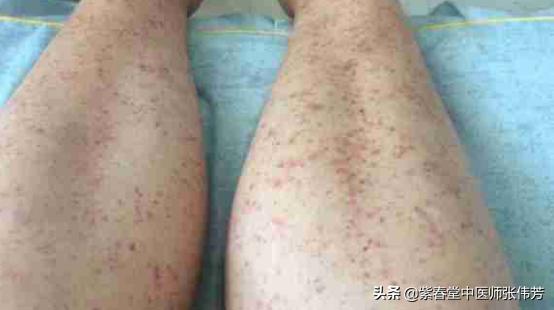 过敏性紫癜留下的色素沉着怎么治,过敏性紫癜出血点都在什么位置