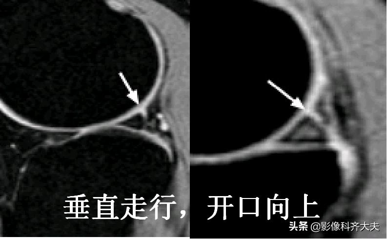 膝关节半月板损伤的磁共振,膝关节半月板病变的mri诊断与鉴别