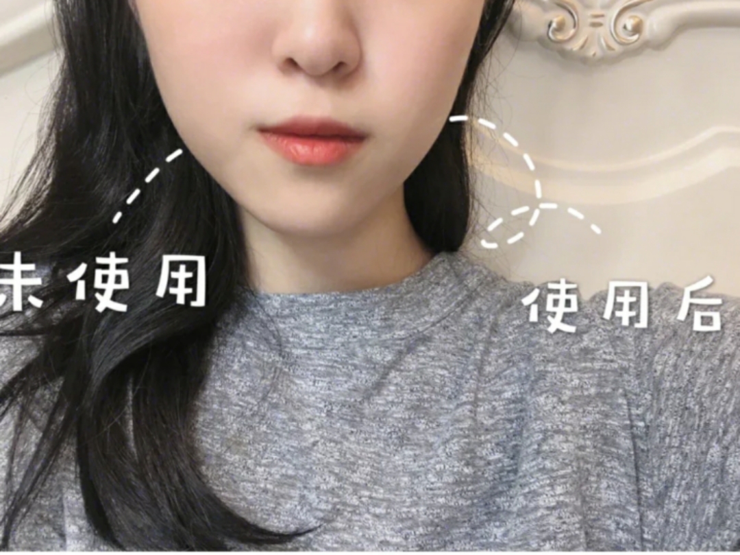 切眼袋会加速衰老的案例,割双眼皮衰老更快