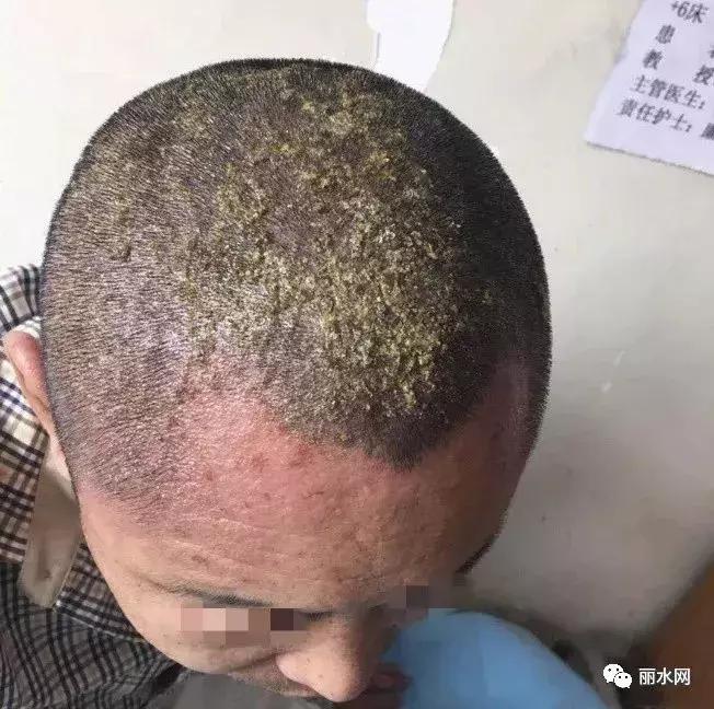 浙江女子一夜之间被毁容,丽水毁容事件