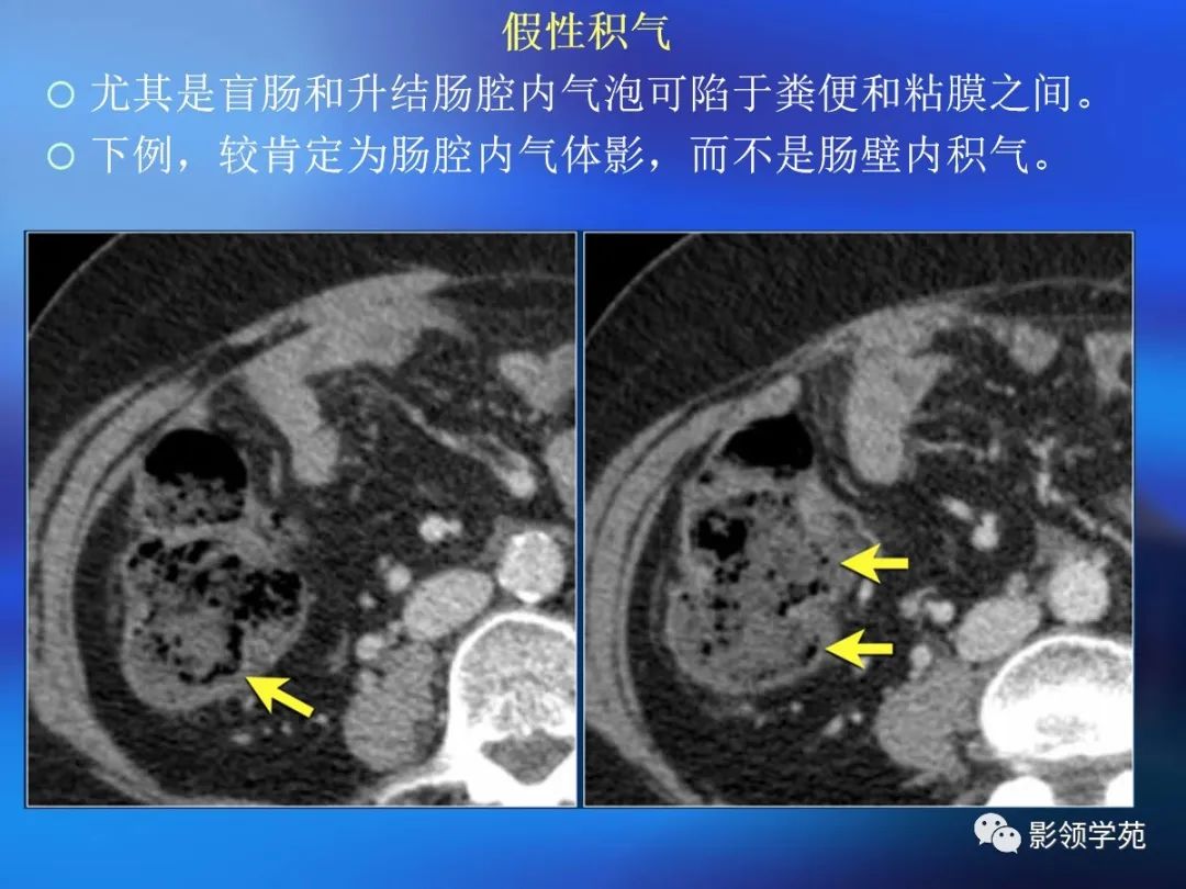 肠道内壁增厚,肠道扩张ct表现