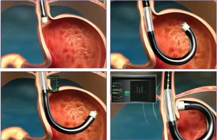 胃食管反流引起咳嗽吃药能缓解吗,胃食管反流咽喉异物感怎么吃药