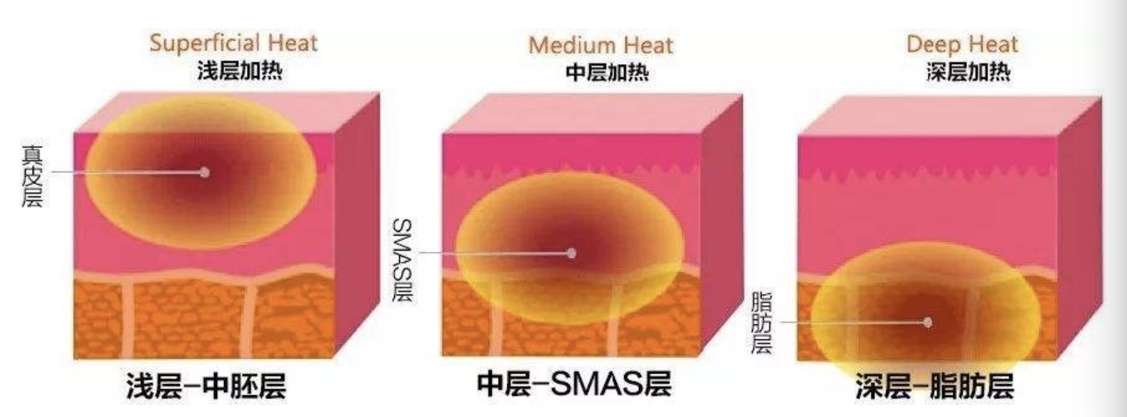 热拉提操作效果对比,热拉提是溶脂还是收紧脂肪