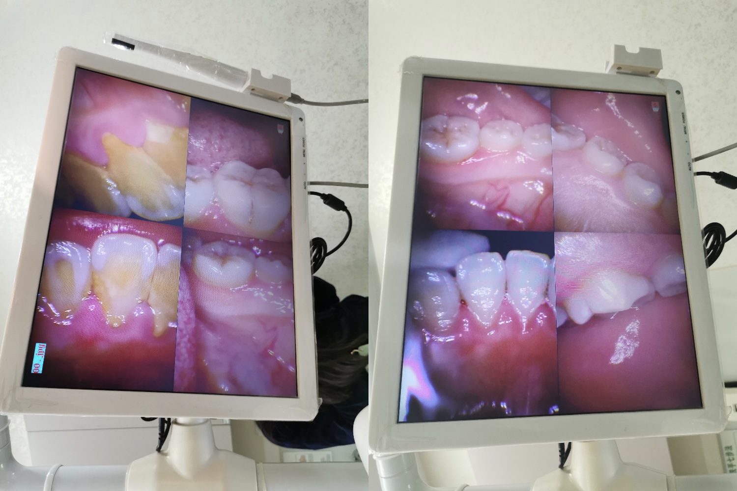 25岁第一次洗牙全过程,40年第一次洗牙的真实感受