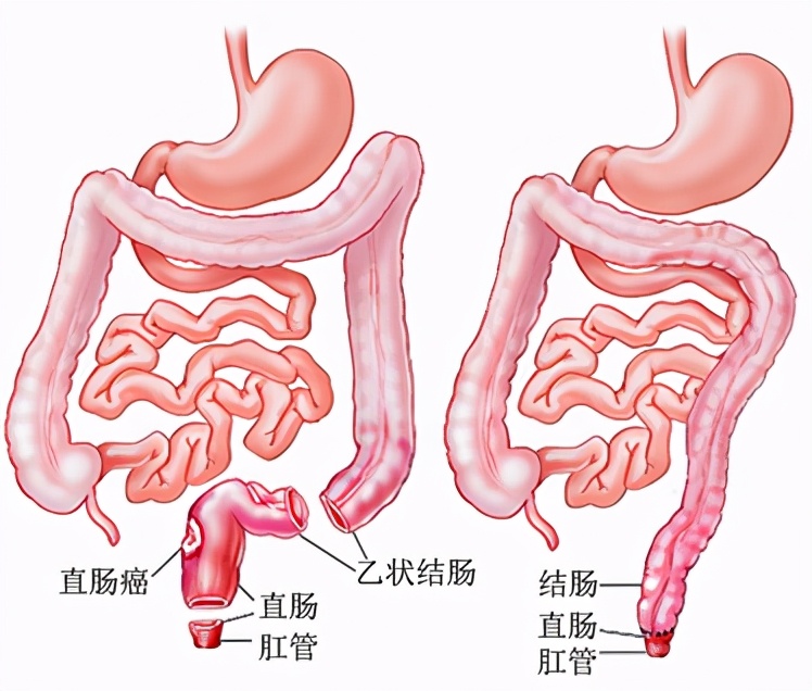 直肠癌手术后为什么大便次数会增多？一般术后多长时间会恢复正常