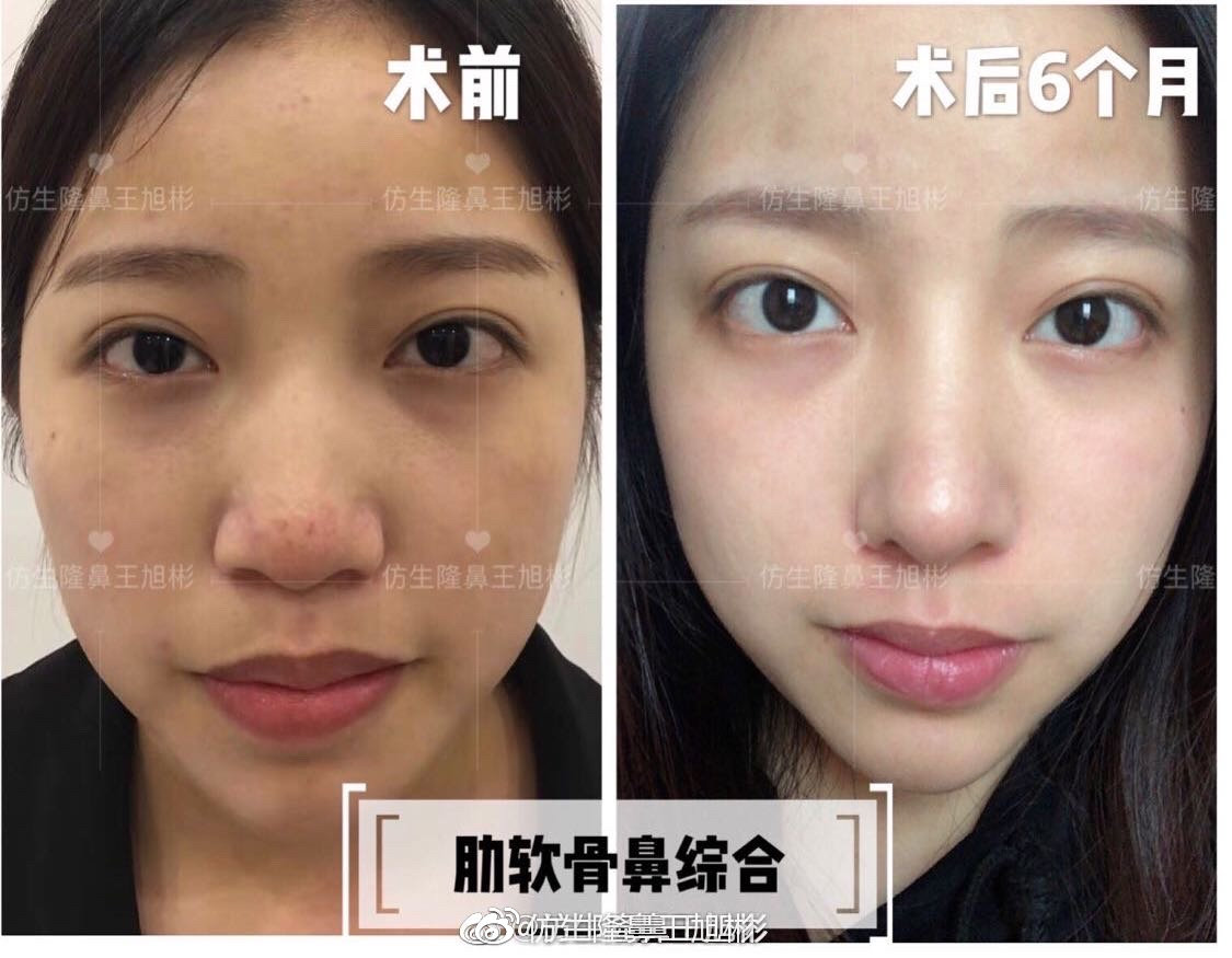 鼻整形最简易方法,鼻孔又大又塌又朝天鼻整形