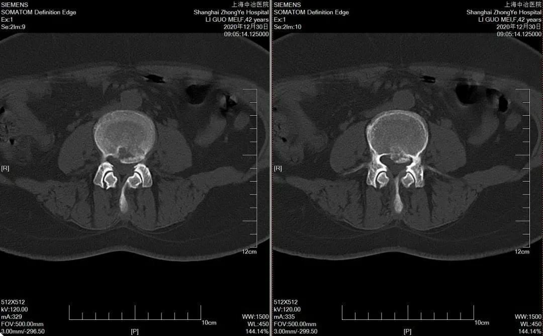 腰疼腿不疼会是椎间盘突出吗,椎间盘突出引起的腰痛怎么治