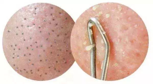 毛孔粗大用什么药膏可以收缩毛孔,毛孔粗大抹啥药物能改善毛孔粗大