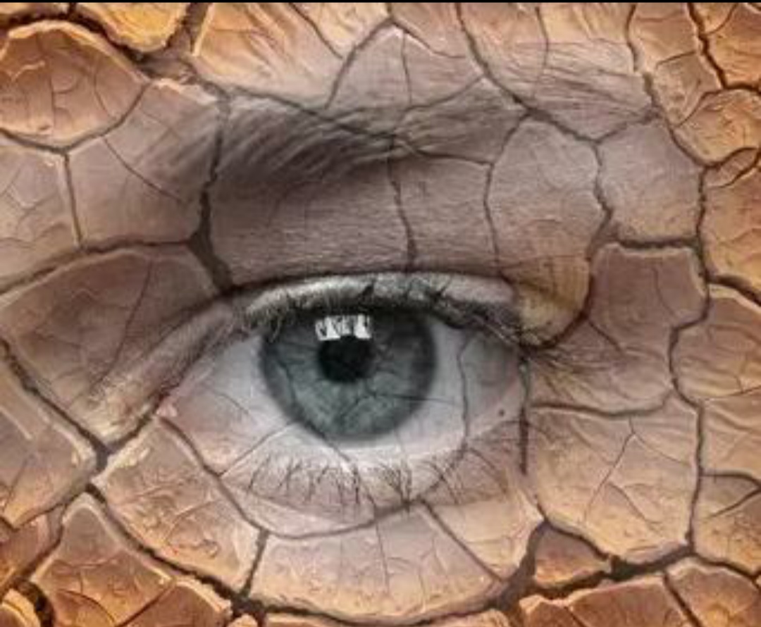 干燥综合症是弥漫性缔结组织病症，破坏自身免疫力，严重的会休克