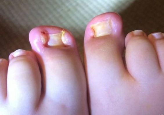 啃指甲拔倒刺危害,手指拔肉刺甲沟炎化脓怎么治