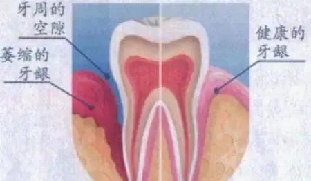 中医有治疗牙龈萎缩的药方吗,艾灸可以治牙龈萎缩吗