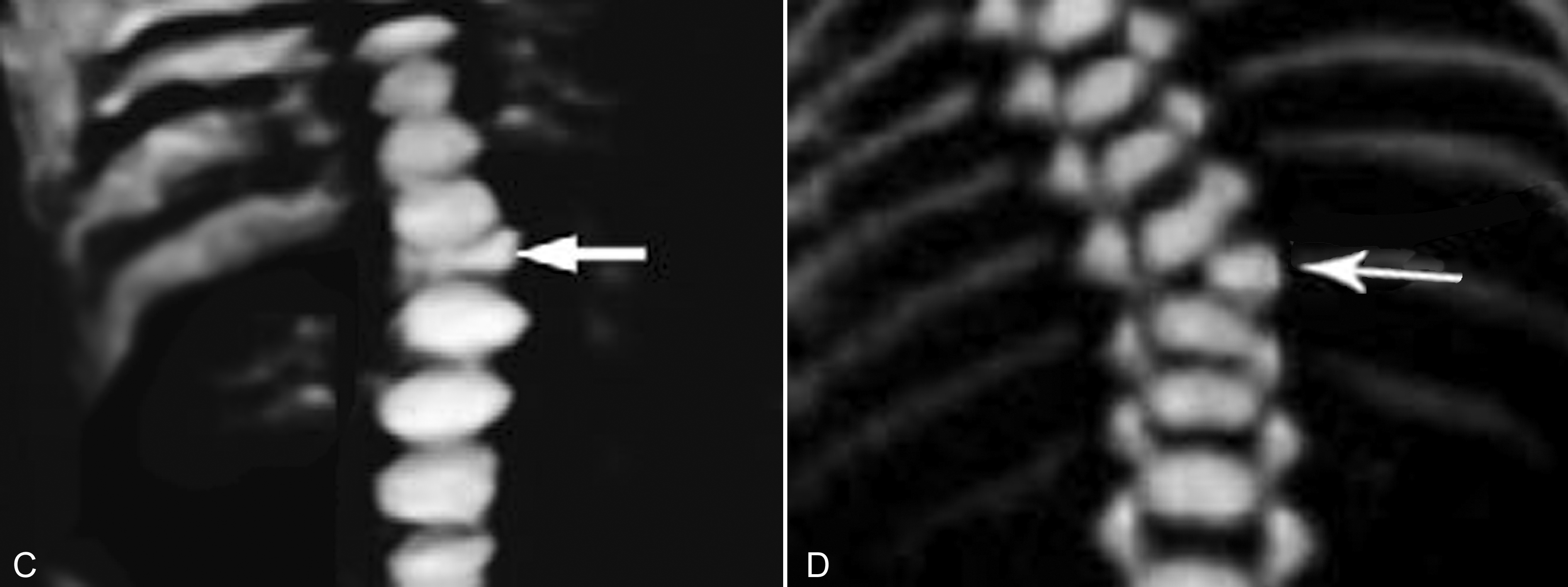 骨密度超声检查,超声全波形