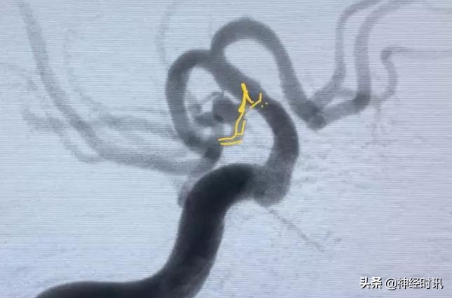 脑血管病介入治疗的介绍,缺血性脑血管病介入治疗进展2015