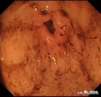 乱吃药伤肝了怎么办,吃药导致出血不止怎么处理