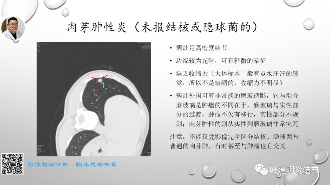 叶建明谈肺实性小结节视频,廖正银教授谈肺结节